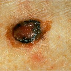 Example of skinCancerAndMelanomas